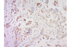 Formalin-fixed and paraffin embedded human breast cancer labeled with SMAD1 Polyclonal Antibody, Unconjugated  at 1:200 followed by conjugation to the secondary antibody and DAB staining (SMAD1 Antikörper  (AA 151-250))