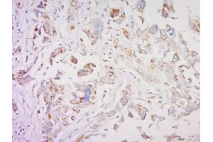 Formalin-fixed and paraffin embedded human breast cancer labeled with SMAD1 Polyclonal Antibody, Unconjugated  at 1:200 followed by conjugation to the secondary antibody and DAB staining (SMAD1 Antikörper  (AA 151-250))