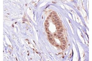 ABIN6267277 at 1/100 staining human Breast carcinoma tissue sections by IHC-P. (Estrogen Receptor alpha Antikörper  (pSer106))