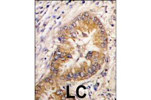 Formalin-fixed and paraffin-embedded human lung carcinoma tissue reacted with CDCA8 polyclonal antibody  , which was peroxidase-conjugated to the secondary antibody, followed by DAB staining. (CDCA8 Antikörper  (Internal Region))