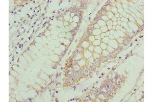 Immunohistochemistry of paraffin-embedded human colon cancer using ABIN7145914 at dilution of 1:100 (CCR1 Antikörper  (AA 306-355))