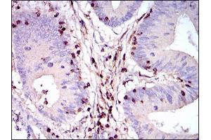 Immunohistochemical analysis of paraffin-embedded colon cancer tissues using PTPRC mouse mAb with DAB staining. (CD45 Antikörper  (AA 928-989))