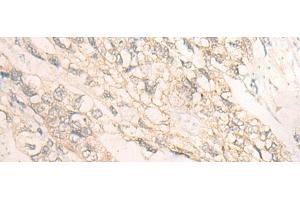 Immunohistochemistry of paraffin-embedded Human gastric cancer tissue using DMTN Polyclonal Antibody at dilution of 1:35(x200) (Dematin Antikörper)