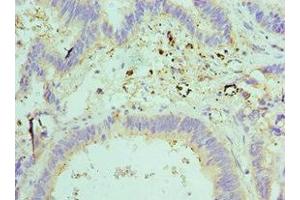 Immunohistochemistry of paraffin-embedded human colon cancer using ABIN7151593 at dilution of 1:100 (TCEB2 Antikörper  (AA 1-118))