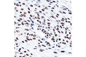 Immunohistochemistry of paraffin-embedded human esophageal cancer using SF3 Rabbit pAb (ABIN1682671, ABIN3018959, ABIN3018960 and ABIN6220644) at dilution of 1:100 (40x lens). (SF3A3 Antikörper  (AA 292-501))