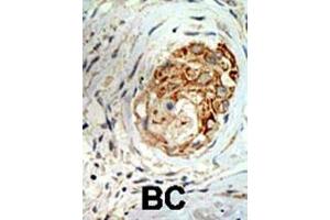 Formalin-fixed and paraffin-embedded human cancer tissue reacted with the primary antibody, which was peroxidase-conjugated to the secondary antibody, followed by DAB staining. (MBD3 Antikörper  (C-Term))