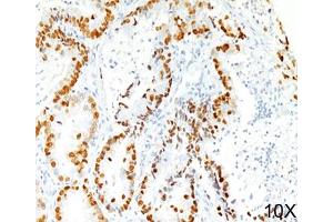 IHC staining of human lung adenocarcinoma (10X) with TTF-1 antibody (8G7G3/1). (TTF1 Antikörper)