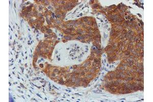 Immunohistochemical staining of paraffin-embedded Carcinoma of Human lung tissue using anti-TULP3 mouse monoclonal antibody. (TULP3 Antikörper)