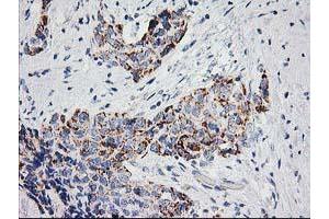 Immunohistochemical staining of paraffin-embedded Adenocarcinoma of Human breast tissue using anti-PPM1B mouse monoclonal antibody.