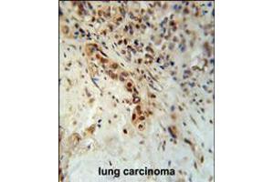 DCLRE1C Antibody immunohistochemistry analysis in formalin fixed and paraffin embedded human lung carcinoma followed by peroxidase conjugation of the secondary antibody and DAB staining. (DCLRE1C Antikörper  (N-Term))