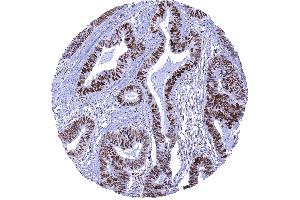 Colon Colorectal adenocarcinoma showing strong MSH6 positivity in cancer cells and moderate staining in stromal cells (Rekombinanter MSH6 Antikörper  (AA 1-100))