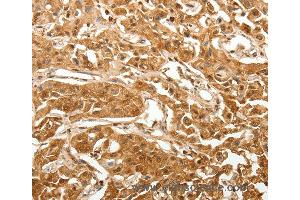 Immunohistochemistry of Human lung cancer using TXN Polyclonal Antibody at dilution of 1:40