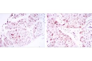 Immunohistochemical analysis of paraffin-embedded ovarian cancer tissues (left) and lung cancer tissues (right) using CDK1 mouse mAb with DAB staining. (CDK1 Antikörper)