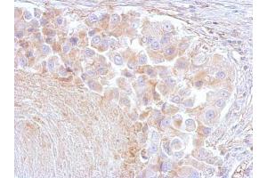 IHC-P Image Annexin VI antibody [C2C3], C-term detects ANXA6 protein at cytosol on human breast by immunohistochemical analysis. (ANXA6 Antikörper  (C-Term))