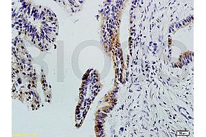 Formalin-fixed and paraffin-embedded : human colon carcinoma labeled with Rabbit Anti-Integrin ?