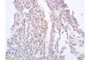 Formalin-fixed and paraffin embedded human lung carcinoma labeled with Anti-BRLF1 Polyclonal Antibody, Unconjugated (ABIN873254) at 1:200 followed by conjugation to the secondary antibody and DAB staining.
