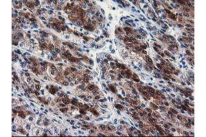 Immunohistochemical staining of paraffin-embedded Carcinoma of Human liver tissue using anti-SEC14L2 mouse monoclonal antibody. (SEC14L2 Antikörper)