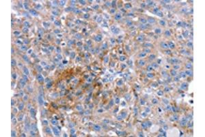 The image on the left is immunohistochemistry of paraffin-embedded Human breast cancer tissue using ABIN7192628(SPATA5L1 Antibody) at dilution 1/20, on the right is treated with synthetic peptide. (SPATA5L1 Antikörper)