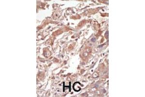 Formalin-fixed and paraffin-embedded human cancer tissue reacted with the primary antibody, which was peroxidase-conjugated to the secondary antibody, followed by DAB staining. (STK10-A Antikörper  (C-Term))