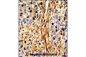 Formalin-fixed and paraffin-embedded human hepatocarcinoma with LB2 Antibody (C-term), which was peroxidase-conjugated to the secondary antibody, followed by DAB staining. (LAMB2 Antikörper  (C-Term))