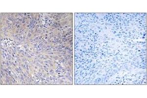Immunohistochemistry analysis of paraffin-embedded human cervix carcinoma tissue, using MRPL11 Antibody.