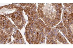 ABIN6276768 at 1/100 staining Human liver cancer tissue by IHC-P.