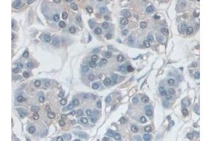 Detection of ERK1 in Human Pancreatic cancer Tissue using Polyclonal Antibody to Extracellular Signal Regulated Kinase 1 (ERK1) (ERK1 Antikörper  (AA 75-312))