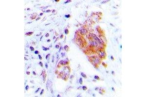 Immunohistochemical analysis of CDC37 (pS13) staining in human lung cancer formalin fixed paraffin embedded tissue section. (CDC37 Antikörper  (N-Term, pSer13))