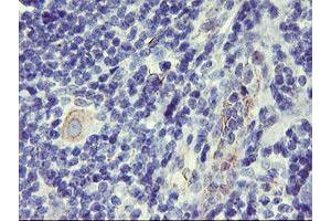 Immunohistochemical staining of paraffin-embedded Human lymphoma tissue using anti-DPP9 mouse monoclonal antibody. (DPP9 Antikörper)