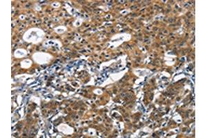 The image on the left is immunohistochemistry of paraffin-embedded Human gastic cancer tissue using ABIN7190434(DCC Antibody) at dilution 1/70, on the right is treated with synthetic peptide. (DCC Antikörper)