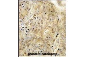 Formalin-fixed and paraffin-embedded human prostata carcinoma tissue reacted with EZH1 Antibody (Center) (ABIN389082 and ABIN2839279) , which was peroxidase-conjugated to the secondary antibody, followed by DAB staining.