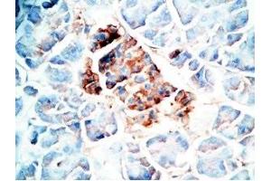 Human pancreas cancer tissue was stained by Rabbit Anti-Oxyntomodulin (H,M,R) Antibody (OXM Antikörper)