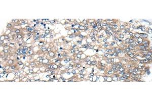 Immunohistochemistry of paraffin-embedded Human liver cancer tissue using BBS12 Polyclonal Antibody at dilution of 1:50(x200) (BBS12 Antikörper)