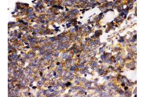 Anti- LAR Picoband antibody, IHC(P) IHC(P): Human Lung Cancer Tissue (PTPRF Antikörper  (Middle Region))