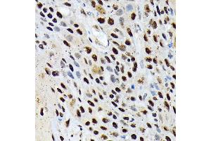 Immunohistochemistry of paraffin-embedded human esophageal cancer using ENT2/SLC29 Rabbit mAb (ABIN7270448) at dilution of 1:100 (40x lens). (SLC29A2 Antikörper)