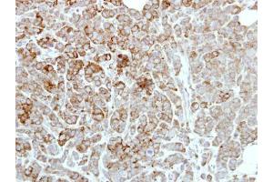 IHC-P Image Immunohistochemical analysis of paraffin-embedded MDAMB468 xenograft, using PDE1A, antibody at 1:500 dilution. (PDE1A Antikörper)