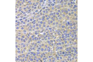 Immunohistochemistry of paraffin-embedded mouse cancer using STAT4 antibody at dilution of 1:100 (x400 lens). (STAT4 Antikörper)