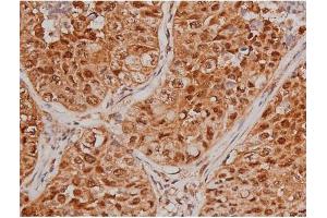 ABIN6267363 at 1/200 staining Human lung cancer tissue sections by IHC-P.