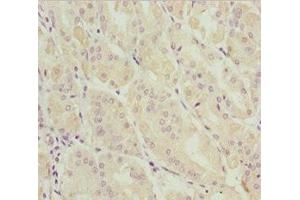 Immunohistochemistry of paraffin-embedded human gastric cancer using ABIN7144962 at dilution of 1:100 (DDX11 Antikörper  (AA 1-220))