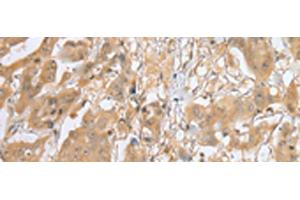 Immunohistochemistry of paraffin-embedded Human breast cancer tissue using MOB4 Polyclonal Antibody at dilution of 1:25(x200)