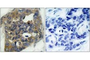Immunohistochemistry analysis of paraffin-embedded human breast carcinoma, using ASK1 (Phospho-Ser966) Antibody. (ASK1 Antikörper  (pSer966))