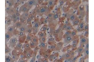 Detection of MBL in Human Liver cancer Tissue using Polyclonal Antibody to Mannose Binding Lectin (MBL) (MBL2 Antikörper  (AA 130-248))
