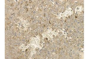 ABIN6256612 and ABIN6267176 at 1/100 staining human melanoma by IHC-P. (INPP5D Antikörper  (pTyr1020, pTyr1022))