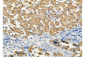 ABIN6259881 and ABIN6277303 at 1/100 staining Human liver cancer and adjacent normal tissues by IHC-P. (ALDH4A1 Antikörper  (C-Term))