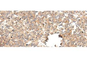 Immunohistochemistry of paraffin-embedded Human esophagus cancer tissue using CACNG5 Polyclonal Antibody at dilution of 1:50(x200) (CACNG5 Antikörper)