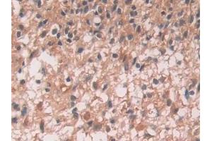 Detection of IL12A in Human Glioma Tissue using Monoclonal Antibody to Interleukin 12A (IL12A) (IL12A Antikörper  (AA 23-219))