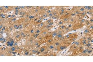 Immunohistochemistry of paraffin-embedded Human liver cancer tissue using ST18 Polyclonal Antibody at dilution 1:50