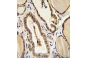 Immunohistochemistry analysis in formalin fixed and paraffin embedded human thyroid tissue reacted with GUCY2D / GUCY2D / RETGC1 Antibody (Center) followed which was peroxidase conjugated to the secondary antibody and followed by DAB staining. (GUCY2D Antikörper  (Middle Region))