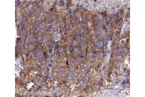 Immunohistochemistry analysis of RANTES antibody in paraffin-embedded human lung carcinoma tissue