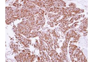 IHC-P Image Immunohistochemical analysis of paraffin-embedded human colon carcinoma, using Angiopoietin 2, antibody at 1:250 dilution. (Angiopoietin 2 Antikörper)